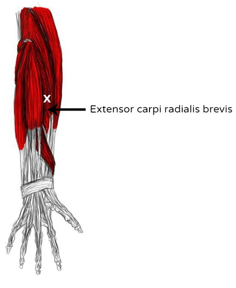 extensor carpi radialis brevis pain trigger points