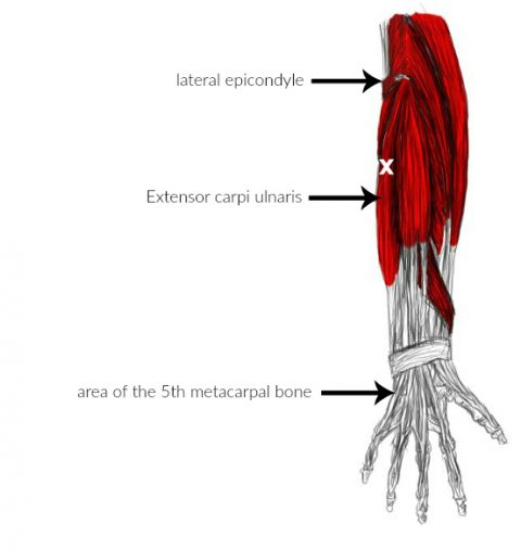 Extensor carpi ulnaris pain trigger points