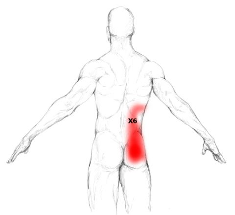 erector spinae muscle pain trigger points