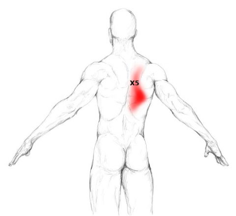 Erector spinae muscle pain & trigger points