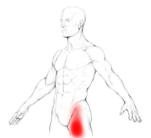 Iliopsoas Muscle Pain Trigger Points