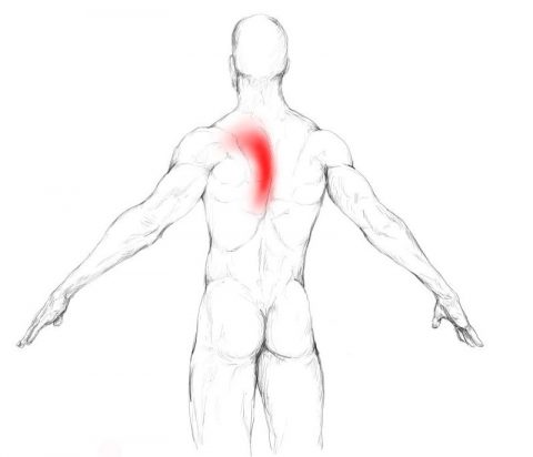 Rhomboid pain & trigger points Rhomboid pain & trigger points