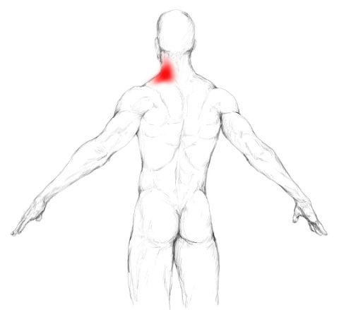 Splenius Capitis Cervicis Pain Trigger Points