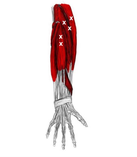 Treat A Tennis Elbow Epicondylitis Yourself