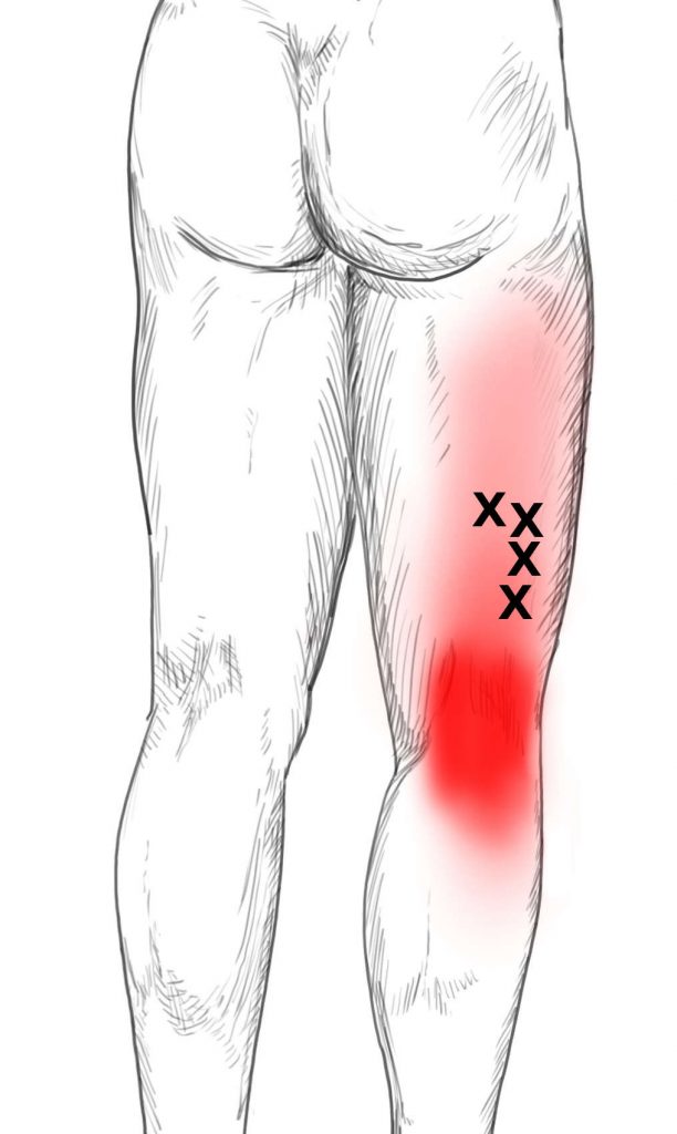 Hamstrings Pain & Trigger Points