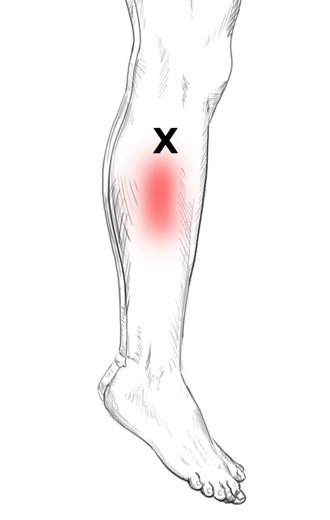 Peroneus Longus Brevis And Tertius Pain And Trigger Points