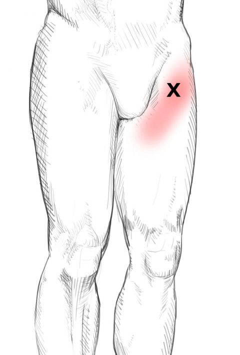 Sartorius – Pain & Trigger Points