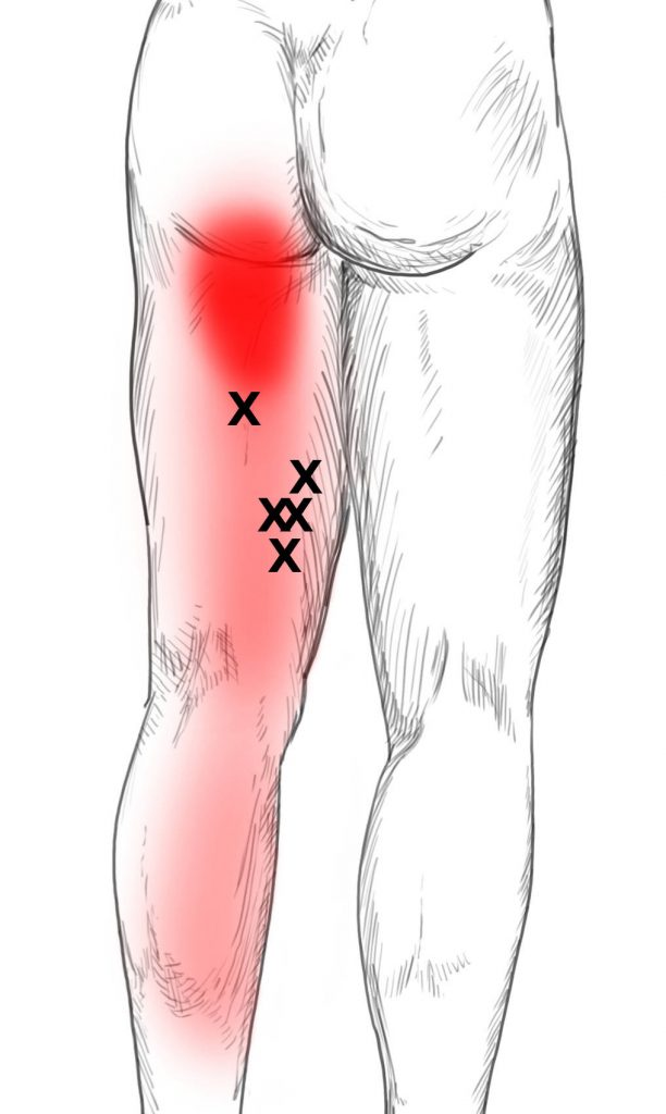 1.1 Pain patterns and trigger points of the semitendinosus and the semimemb...