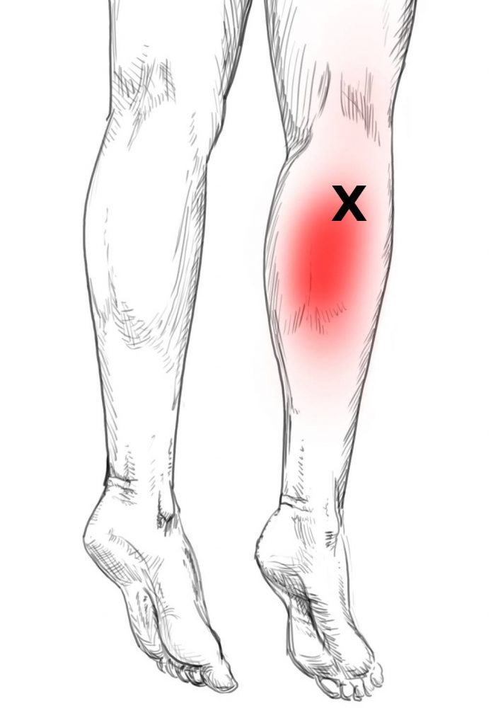 Soleus Pain & Trigger Points