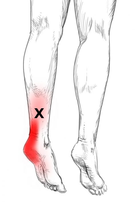 Soleus Pain Trigger Points Soleus Pain Trigger Points