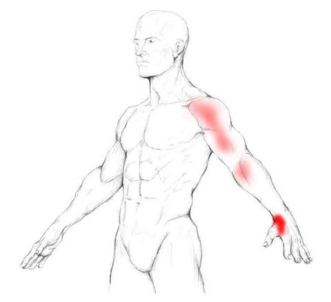 Brachialis muscle pain & trigger points