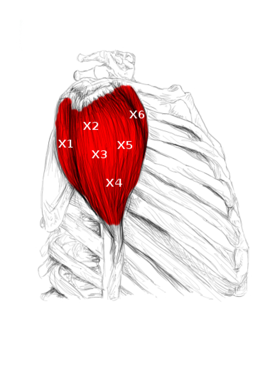 Deltoid muscle pain & trigger points