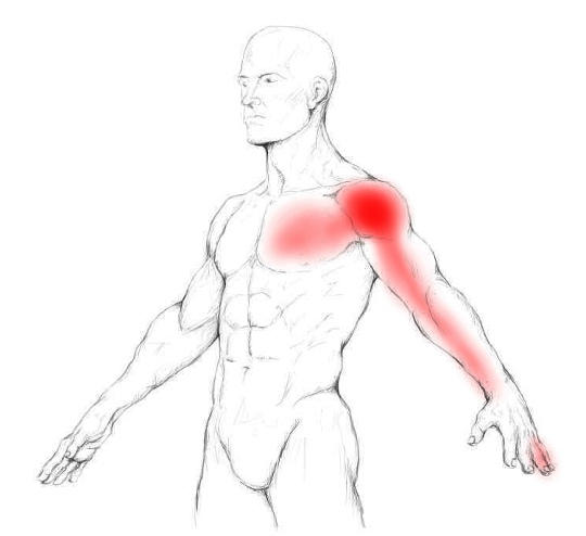 Pectoralis minor pain & trigger points