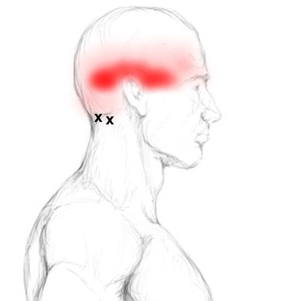 Suboccipital Muscles Pain & Trigger Points