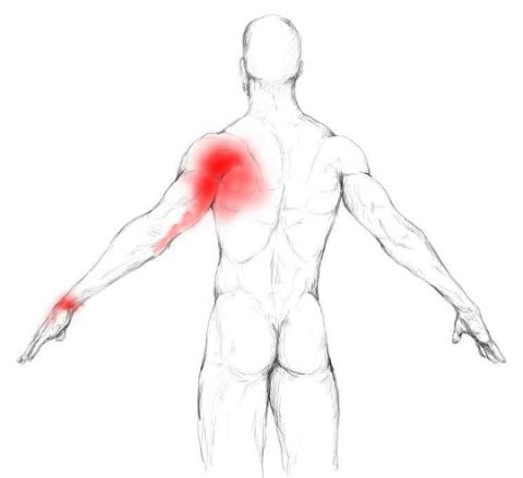 Subscapularis muscle pain trigger points